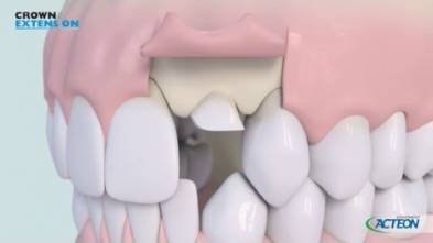 ACTEON crown extension