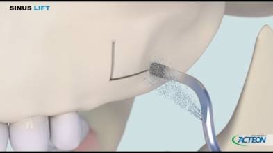 ACTEON Sinus Lift