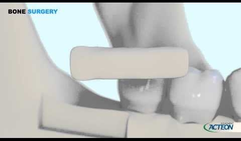 PIEZOTOME® BONE SURGERY (*) 3D PROTOCOL