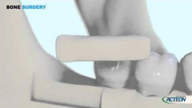 PIEZOTOME® BONE SURGERY (*) 3D PROTOCOL