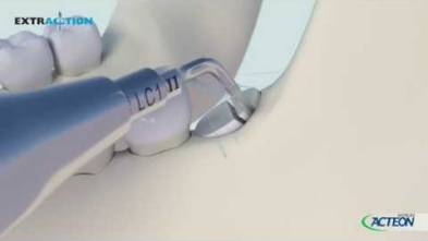 PIEZOTOME® EXTRACTION(*)  3D PROTOCOL