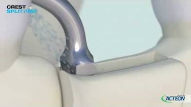 PIEZOTOME® Crest Splitting / 3D Protocol