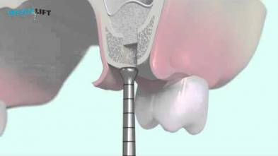 Bone Surgery official Intralift® protocol 3D in 2013