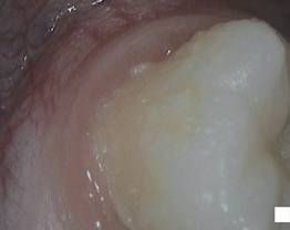 SOPROCARE - Clinical case 1