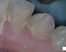 SOPROCARE - Clinical case 2