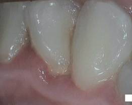 SOPROCARE - Clinical case 4