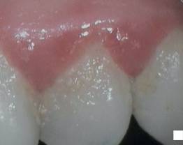 SOPROCARE - Clinical case 5