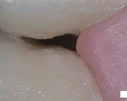 SOPROCARE - Clinical case n°8