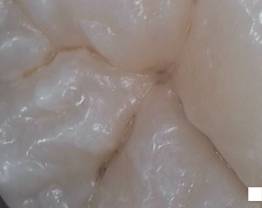 SOPROCARE - Clinical case 11