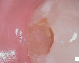 SOPROCARE - Clinical case 13