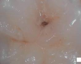 SOPROCARE - Clinical case 14