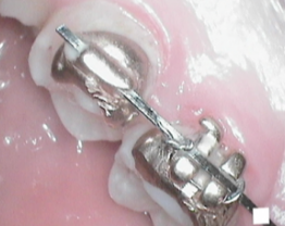 SOPROCARE - Orthodontics n°2