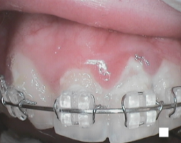 SOPROCARE - Orthodontics n°4