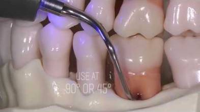 PERIODONTICS TIPS ACTEON