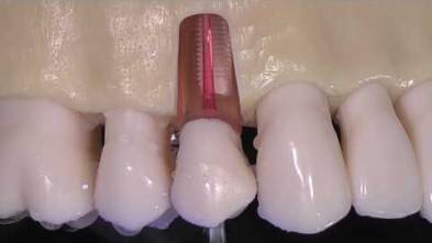 ENDODONTIC TIPS ACTEON