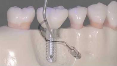 IMPLANT CARE TIPS ACTEON