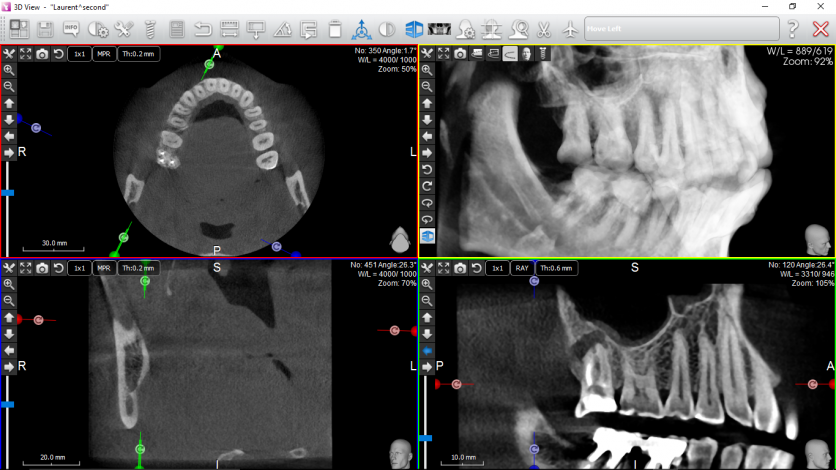 Endo - infection sinus
