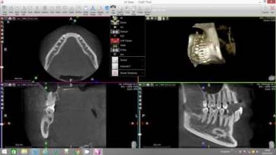 Virtual Endoscope Mandibular Nerve X-Mind Trium