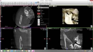 X-Mind Trium 3rd molar virtual endoscope