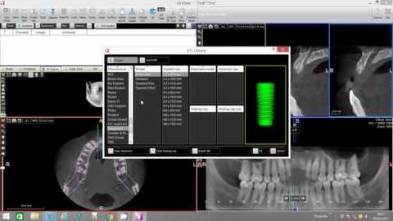 Implant Placement with Bone Density Assessment - X-Mind Trium
