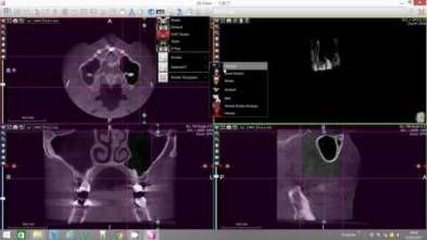 Sinus Volume Assessment - X-Mind Trium