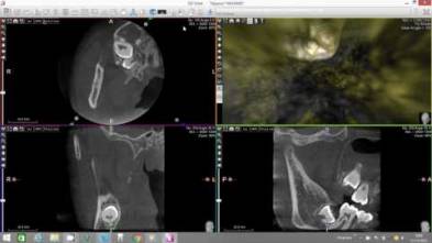 X-Mind Trium Endodontic Virtual Endoscope in AIS
