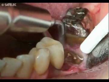 Piezotome Extraction of Fractured Root Using LC1