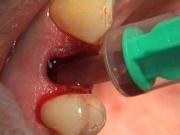 Bone Surgery Extraction by Prof F. Louise 2010