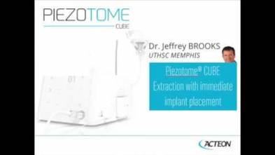 Immediate implantation following extraction Dr Brooks