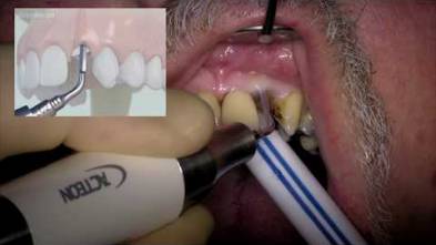 Atraumatic Extraction with Immediate Implant Placement - Dr Abdah