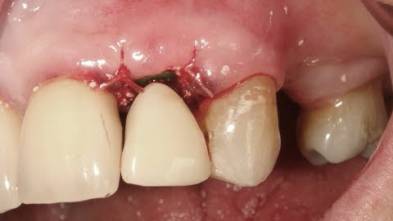 Broken Lateral Incisor - Dr Abdah
