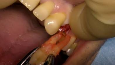 Bilateral Teeth Fracture - Dr Abdah