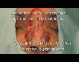 Rhinoplasty Comparison Piezo vs mechanical instruments_Dr Gerbault & Dr Palhazi