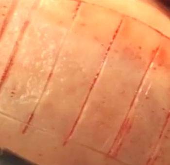 Cranial surgery Dr Solyom