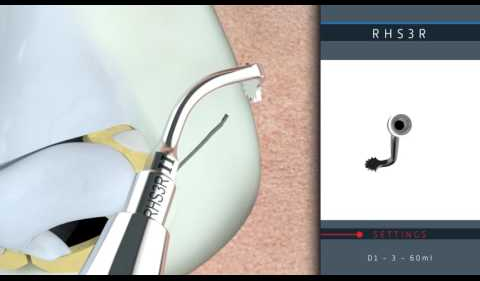 Ultrasonic Rhinoplasty 3D protocol