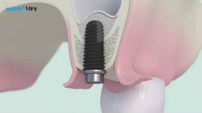 Intralift 3D protocol