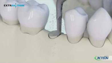 Bone Surgery_Extraction 3D protocol