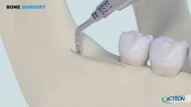 Bone Surgery_Bone graft 3D protocol