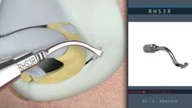 Ultrasonic rhino-septoplasty 3D protocol