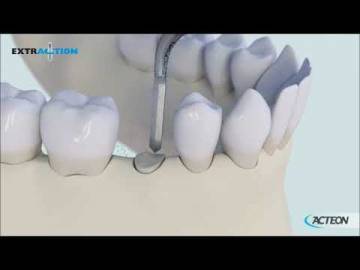 Surgery Extraction 3D PROTOCOL