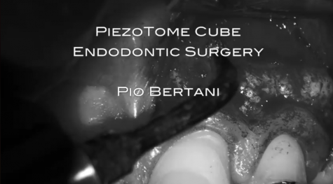 Endodontic surgery with the Piezotome® Cube: Dr. Pio Bertani clinical case