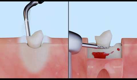 3D PIEZO vs ROTATIVE