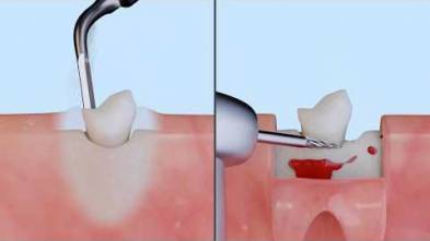 3D PIEZO vs ROTATIVE