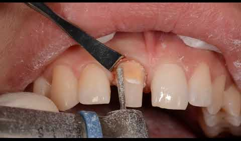 GingiProtect Acteon EN
