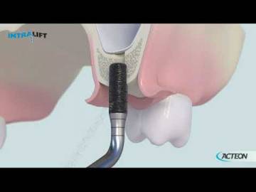 PIEZOTOME TKW PROTOCOLE