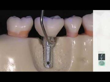IP1 IMPLANT CARE