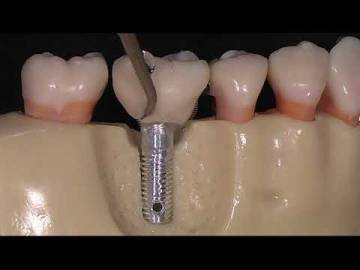 PH1 PH2L PH2R IMPLANT CARE