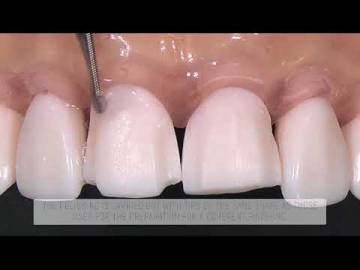 PMV4 PMV5 PMV6 PROSTHESIS