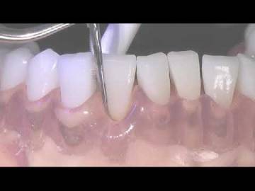 TK1 1S TK1 1L PERIODONTICS