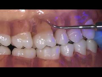 TK2 1L TK2 1R PERIODONTICS